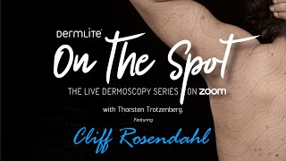 DermLite On the Spot Dermoscopy Series  Dr Cliff Rosendahl [upl. by Esej179]