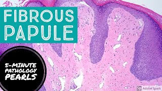 Fibrous Papule Angiofibroma 5Minute Pathology Pearls [upl. by Merrielle]