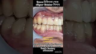 Clear Aligners Retainers after Brace Treatment Todays Dentistry 01309007221 [upl. by Muhcan]