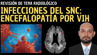 Radiología en 5 minutos Infecciones del sistema nervioso central Encefalopatía por VIH [upl. by Nike]