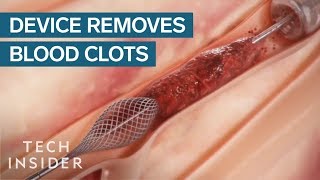 How This Device Safely Removes Blood Clots  Tech Insider [upl. by Ahsemrak843]