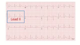 Corrected QT interval QTc on electrocardiogram part 2 [upl. by Nohsal984]