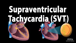 Supraventricular Tachycardia SVT PSVT Animation [upl. by Holleran975]