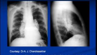 Chest xray interpretation Sarcoidosis [upl. by Eiramnaej]