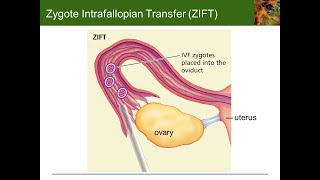 Zygote intrafallopian transfer as a type of assisted reproductive technology [upl. by Akinod]