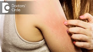 5 Top Causes of Itchy skin  Dr Urmila Nischal [upl. by Esinek532]