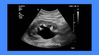 Large ureteral calculus with hydronephrosis ultrasound imaging prognosis and management [upl. by Elehcar]