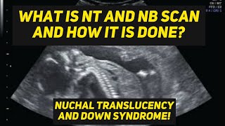 NT and NB scan  Nuchal translucency scan  Learn Ultrasound Techinques [upl. by Ayerf]