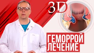 Геморрой лечение подробное видео [upl. by Elna]