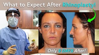 What Can I Expect During Rhinoplasty Recovery One Day to Three Weeks PostOp [upl. by Uriel351]