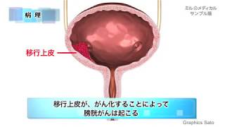 膀胱がん／家庭の医学動画版 ミルメディカル [upl. by Benge789]