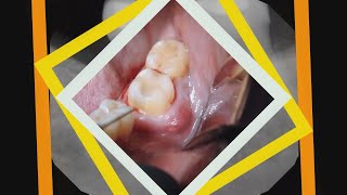 Drainage and Extraction of Lower Molar Abscess [upl. by Osbourne682]