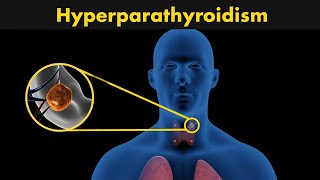 How hyperparathyroidism occurs  DiagnosisTreatment and symptoms of hyperparathyroidism [upl. by Blanch]