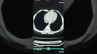 CECT whole abdomen IV Contrast [upl. by Lraed]