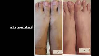 mesopeel melanoplus before and after نتائج تقشير ميلانوبلس [upl. by Stevena907]