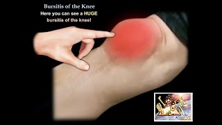 Knee Bursitis  Everything You Need To Know  Dr Nabil Ebraheim [upl. by Yran]