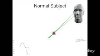 A new saccadic indicator of peripheral vestibular function based on the video head impulse test [upl. by Leban]