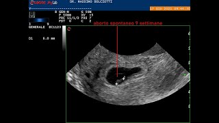 aborto spontaneo alla nona settimana di gestazione [upl. by Lunn14]