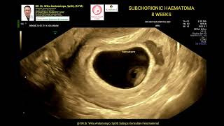 Subchorinic Haematoma 8 weeks [upl. by Ecinahc370]