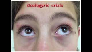 Oculogyric crisis mrcpch Communication [upl. by Holder]