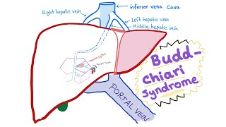 BuddChiari syndrome  Definition Causes Pathophysiology Diagnosis amp Treatment  Hepatology [upl. by Ennael]