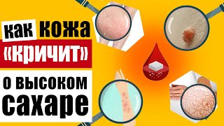 Предупреждающие признаки на коже которые говорят о высоком уровне сахара в крови [upl. by Aizirk]