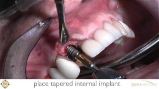 Single Tooth Replacement with BioHorizons Tapered Internal with LaserLok by Dr Pikos 2011 [upl. by Yrred]