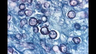 Histoplasmosis Systemic Mycoses 1 Microbiology MCQs [upl. by Airbmat]