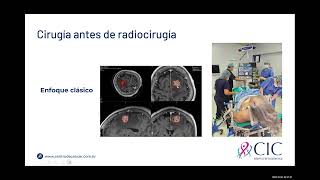 Dr Eduardo Lovo  Radiocirugía preoperatoria en Metástasis a Cerebro  CIC [upl. by Navek166]