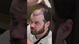 Hair Transplant 5 month Result  Hair Transplant Timelapse  Hair Transplant in Turkey [upl. by Viquelia520]