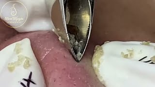 Nose Zone Precision Blackhead Extraction [upl. by Mimajneb991]