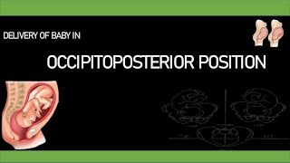 Mechanism of Occipitoposterior Labour  Long Rotation [upl. by Yruy306]