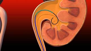 Ureteral Obstruction  Retrograde insertion of Resonance stent [upl. by Asha]