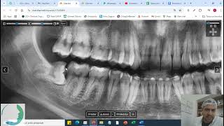 MayLuiFraCar  Exodontia dos sisos  Biomaterial [upl. by Eshelman123]