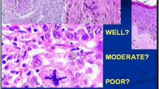 Medical School Pathology Chapter 7n [upl. by Jaymee]