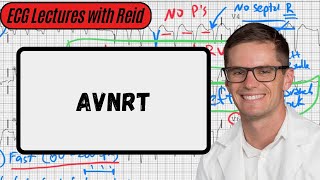 AV Nodal Reentry Tachycardia  Day 16 ECG Challenge [upl. by Dev]