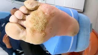 Remove severe massive plantar warts  Satisfying amp Relaxing Video38 [upl. by Terrye]