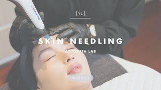 Skin Needling at Youth Lab [upl. by Syl]