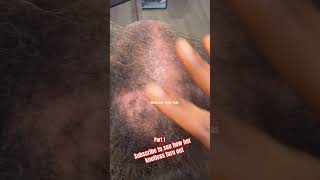 braids alopecia haircare knotlessbraids braidedhairstyles hairloss hair thinning how to [upl. by Bain33]