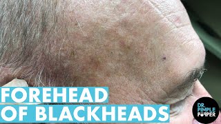 A Forehead of Blackhead Extractions Dr Pimple Popper Mines a Patients Head [upl. by Carol]