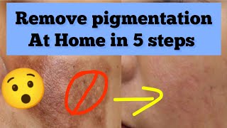 5 Easy Steps to remove Pigmentation [upl. by Ardnuhsor]