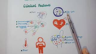 What is infective endocarditis Morphology clinical feastures Dukes criteria [upl. by Yla]