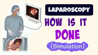 Laparoscopic Surgery How is it done simulation [upl. by Adehsor]