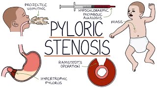 Understanding Pyloric Stenosis [upl. by Akinom]