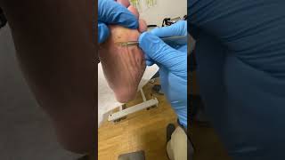 Get ready for relief Check out how an Aussie Podiatrist tackles tough Forefoot Corns [upl. by Julia]