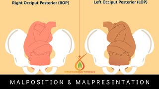 Occipitoposterior presentation [upl. by Felder]