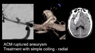 Ruptured Aneurysm Right MCA  Coiling  Radial [upl. by Howland765]