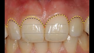 Gingivectomy guide with digital workflow Cerec amp Varseo XS [upl. by Ydnagrub529]