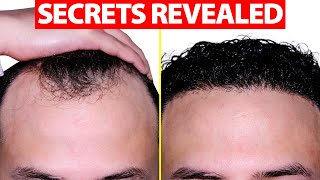 How to Fix Your Receding Hairline [upl. by Ariamo]