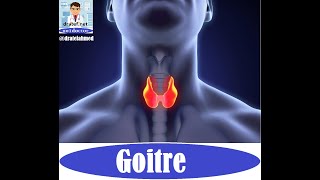 Goitre Thyroid Gland DiseasesCase Presentation  Medical Case Study Case Discussion Case Report [upl. by Yelsa]